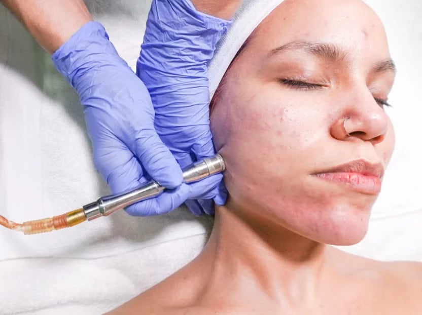 Gloved provider treating a patient’s cheek with a handheld device