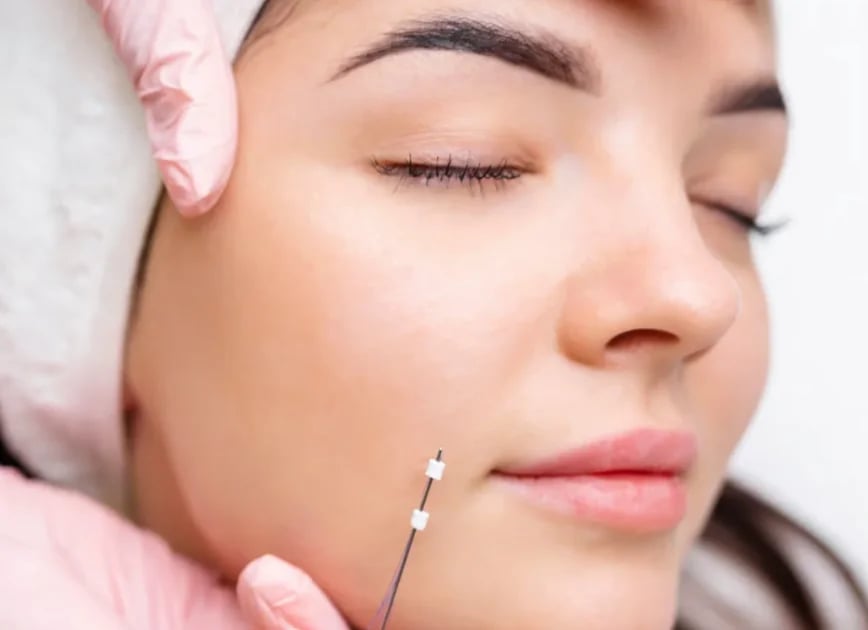 Gloved hands guiding a fine thread cannula along the lower cheek of a woman lying back with her eyes closed